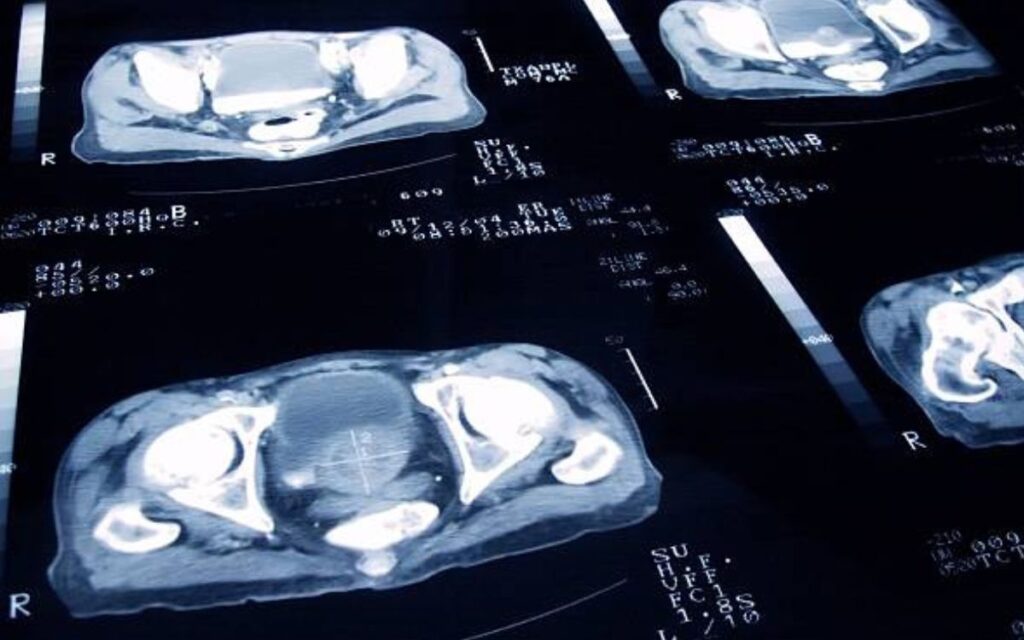 Are Prostate Tumors Ever Benign?