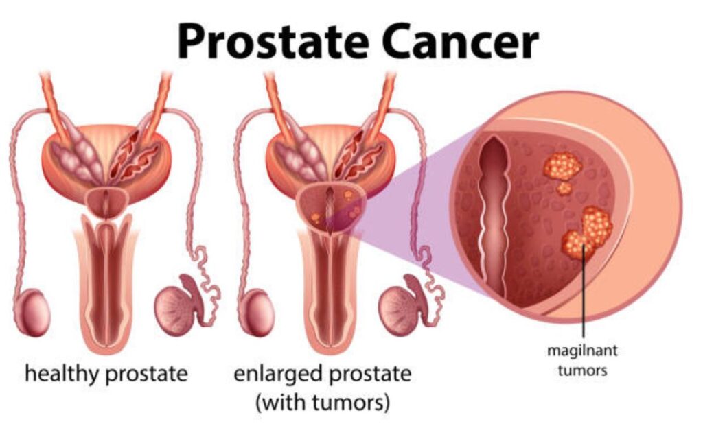 How Long Does Prostate Cancer Take to Develop?